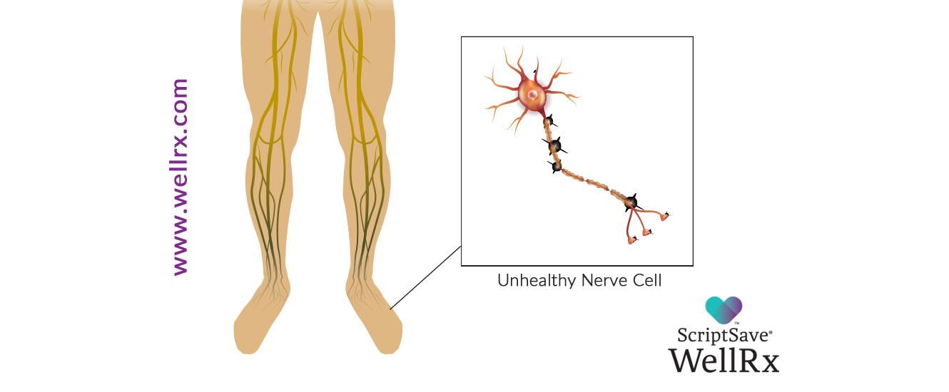 neuropathy