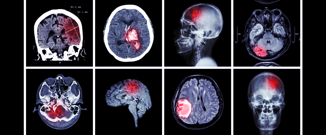 stroke-ct-scan